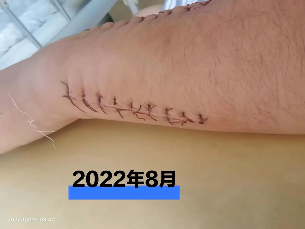 掰手腕胳膊被掰骨折,上门取货_123随叫随到